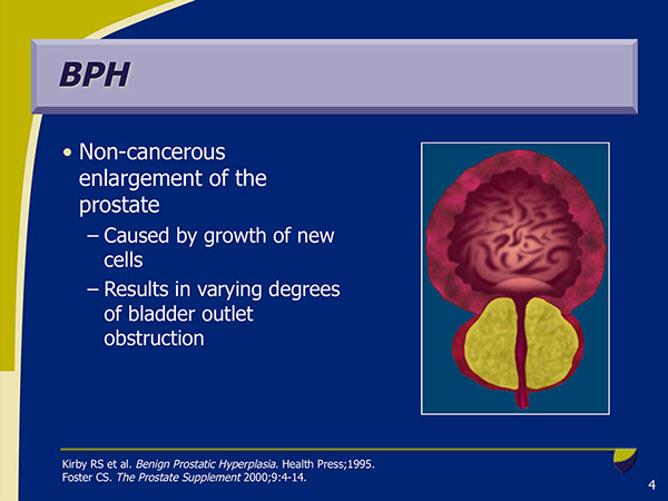 BPH Disease Progression | Medical Meeting PPT Slides