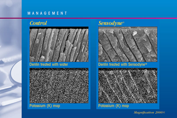 Dentinal Hypersentivity Educational Presentation | Medical Meeting PPT Slides