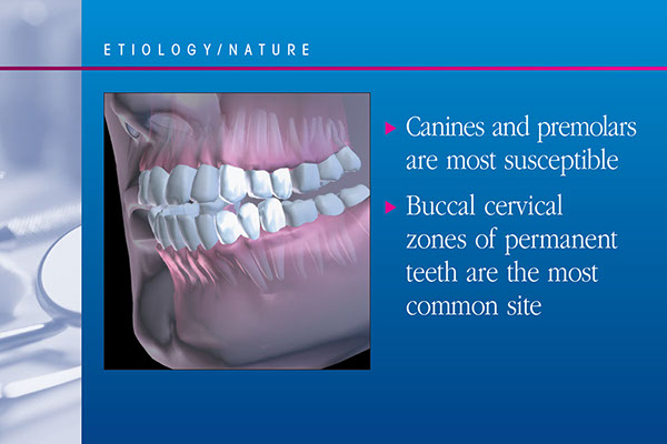 Dentinal Hypersentivity Educational Presentation | Medical Meeting PPT Slides